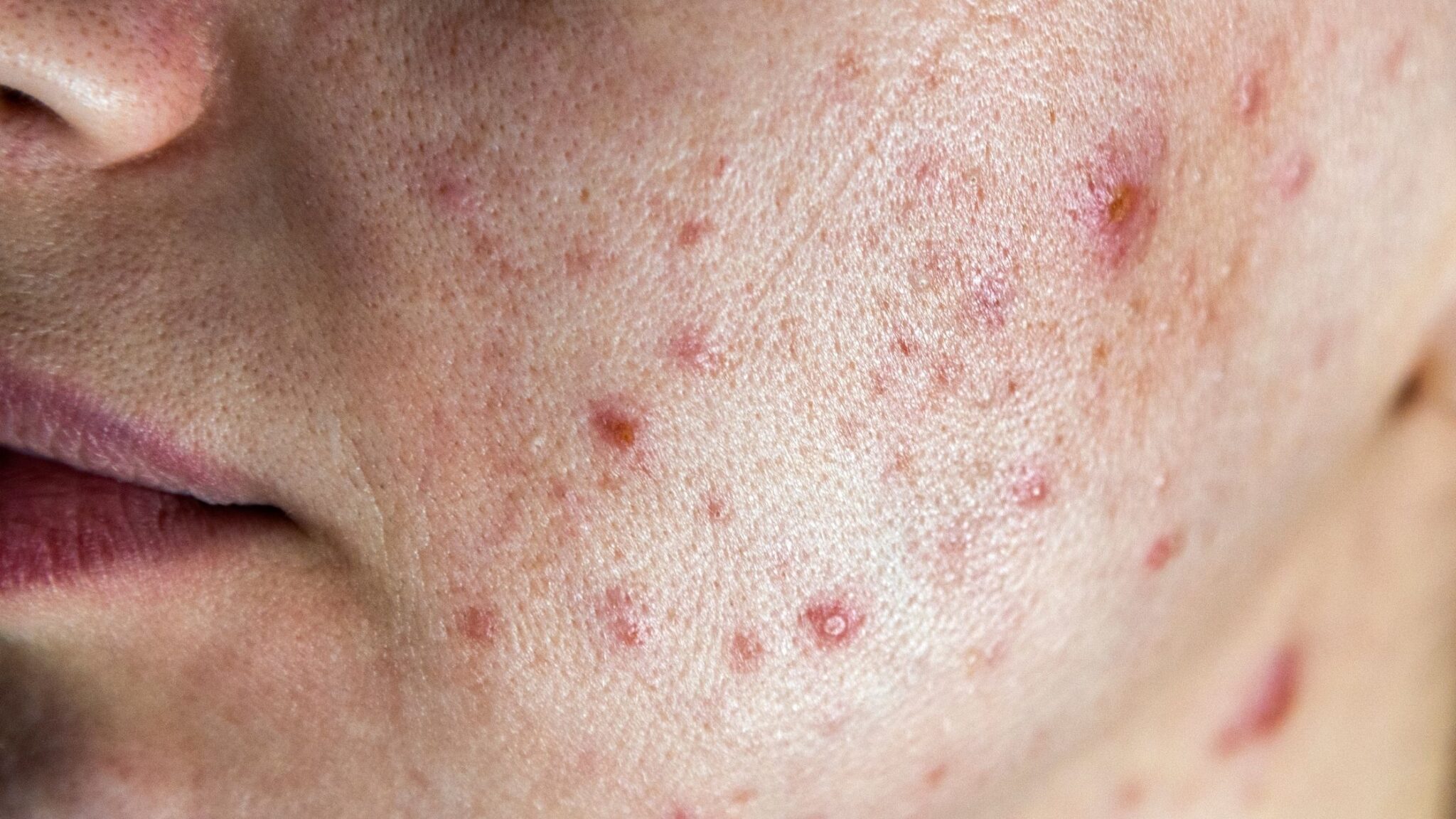Acne Fúngica x Acne Comum: Como Diferenciar e Tratar Corretamente