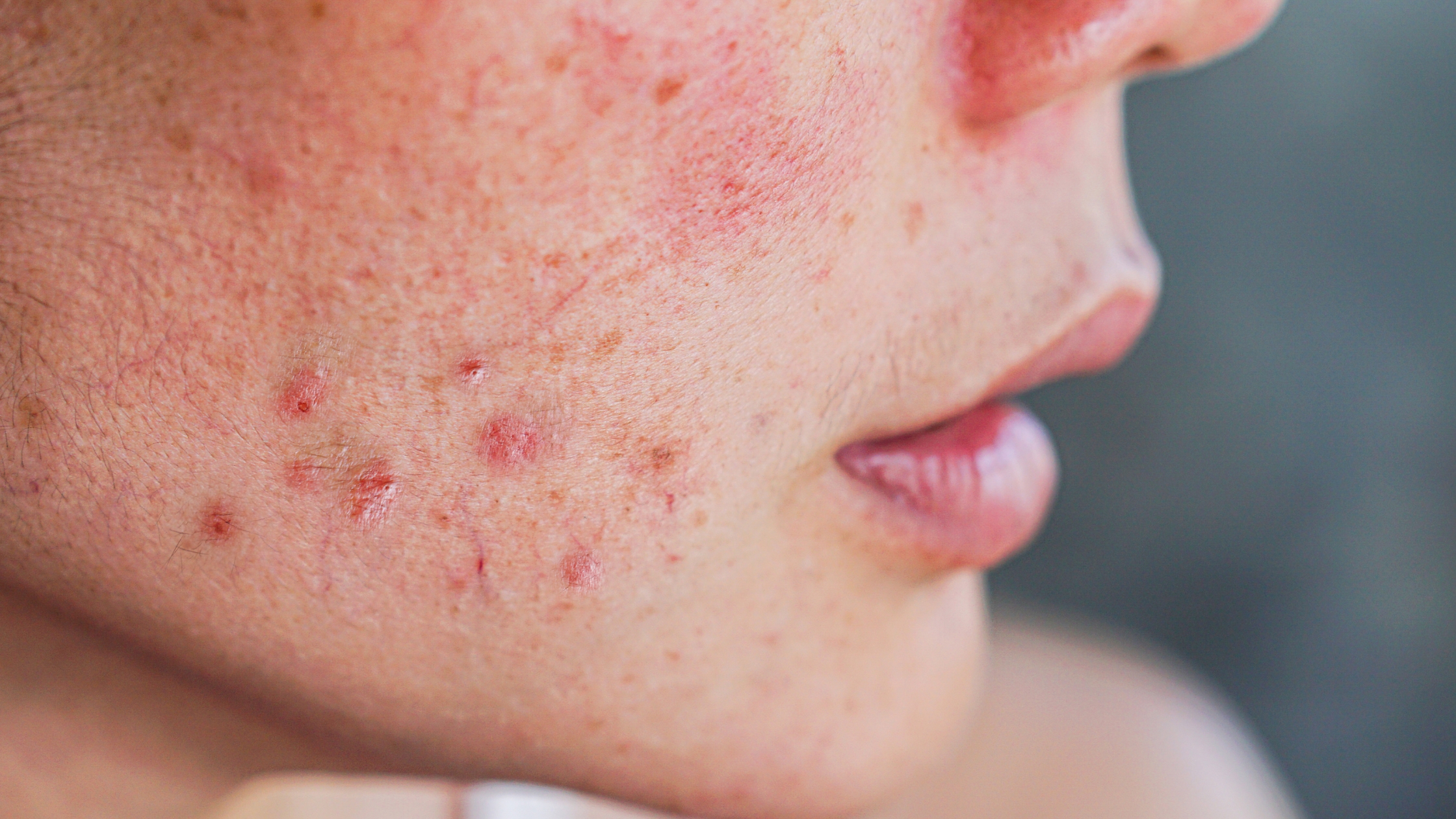 pele com acne